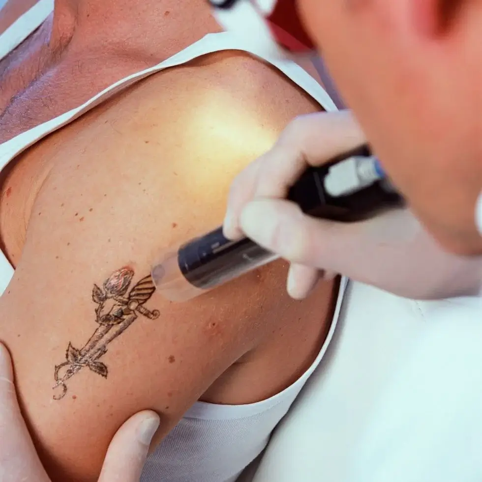 Can You Get A Tattoo A Month Before Surgery