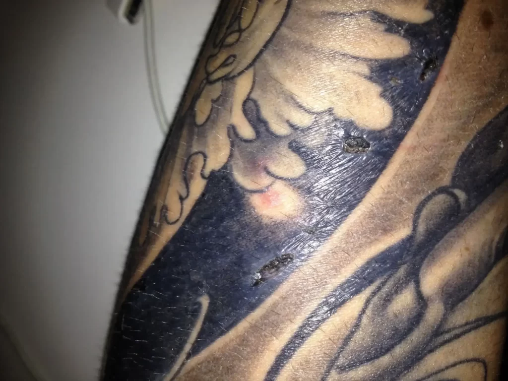 Chunks Of Skin Missing From Tattoo