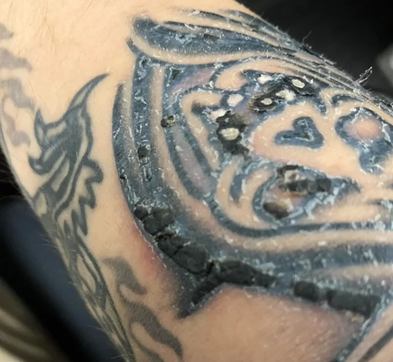 Tattoo Scab Fell Off Raw Skin Underneath