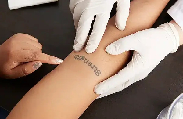 Is Laser Tattoo Removal Painful