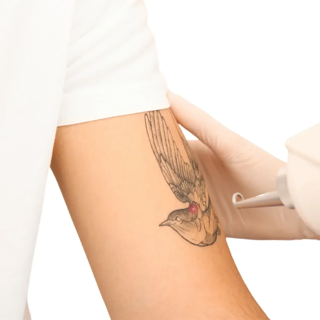 What Are Laser Tattoo Removal Side Effects