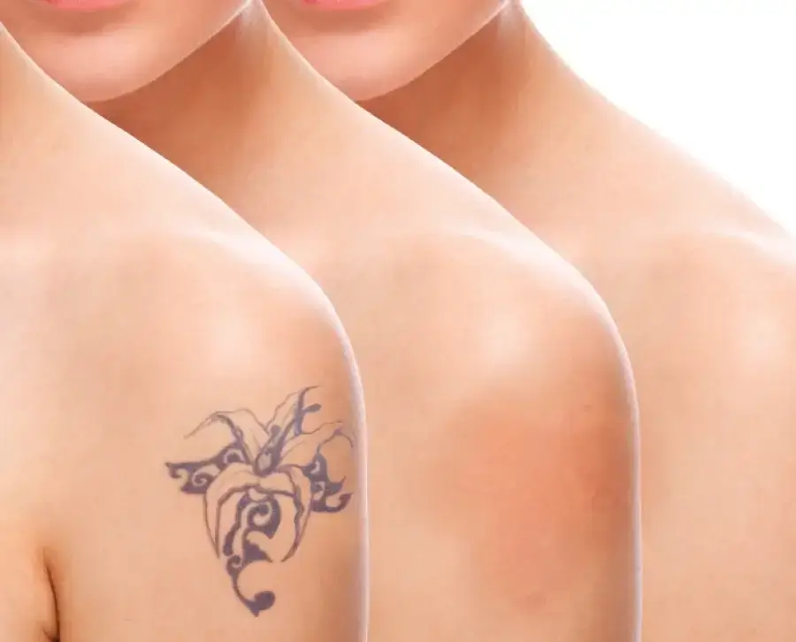 How Does Laser Removal Work