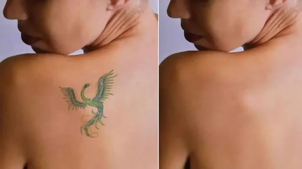 Laser Tattoo Removal After 3 Sessions