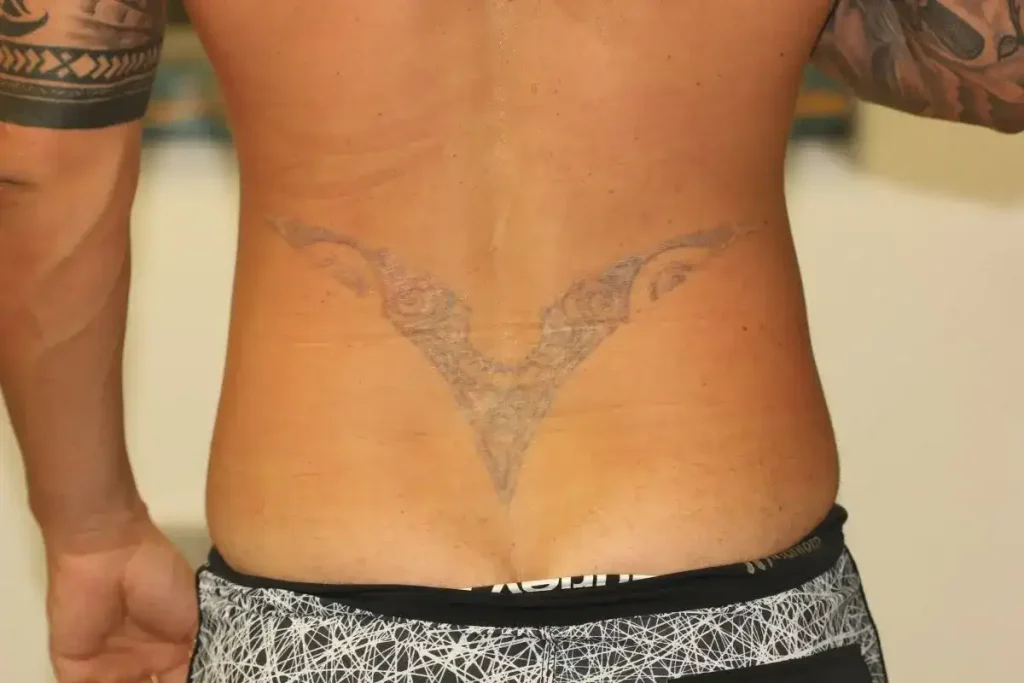 5 Factors That Determine The Cost Of Tattoo Removal