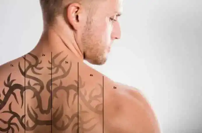 How Much Does Laser Tattoo Removal Cost