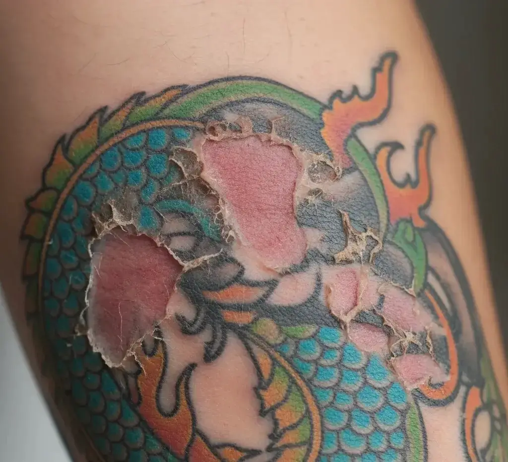 Can Allergic Reactions Cause Chunks of Skin to Come Off a Tattoo?