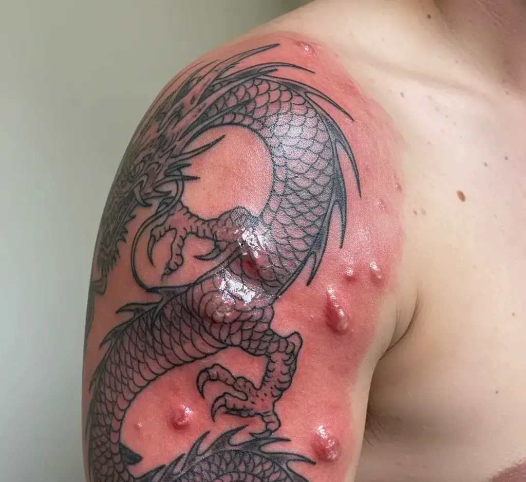 will cellulitis ruin the tattoo