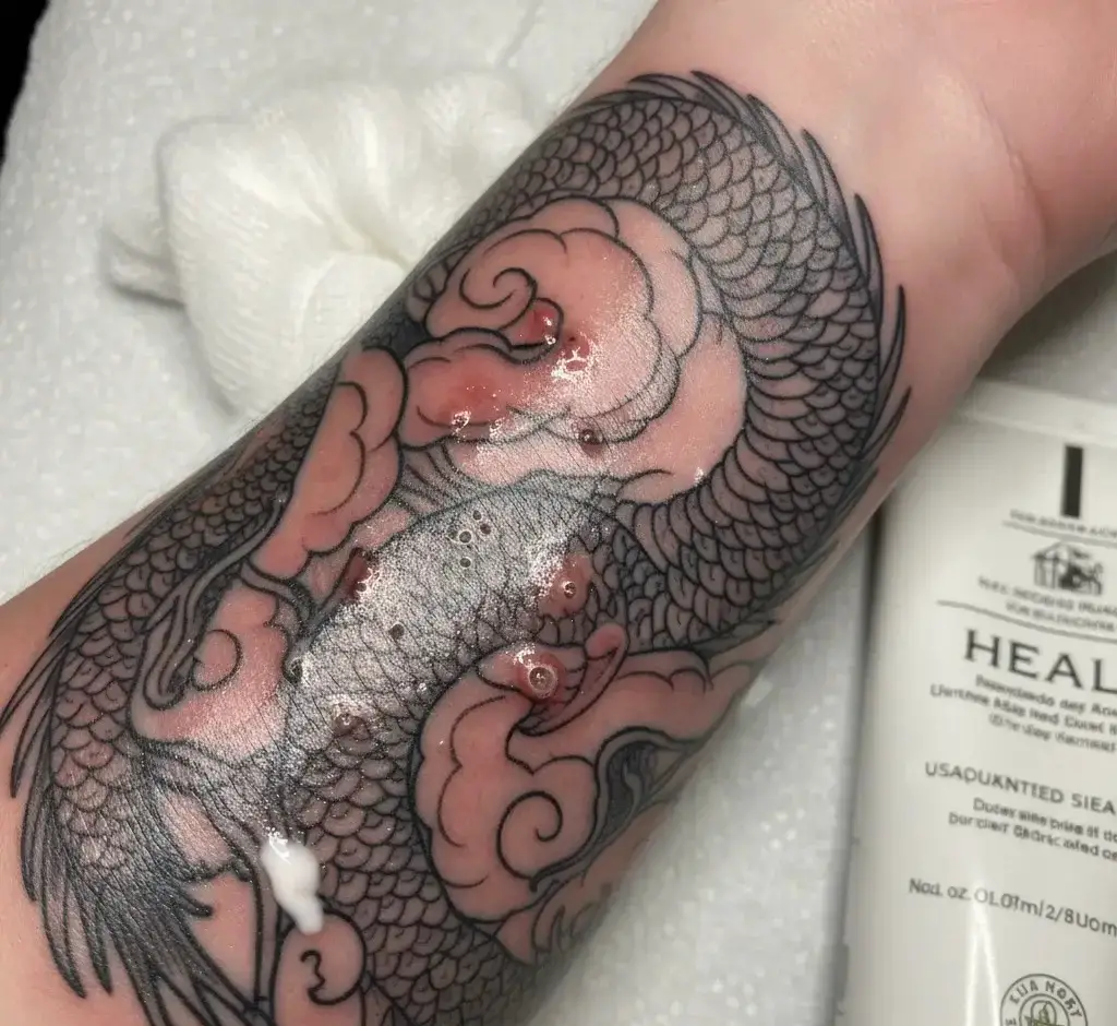 When to Seek Medical Help for a Burning Tattoo After Lotion?