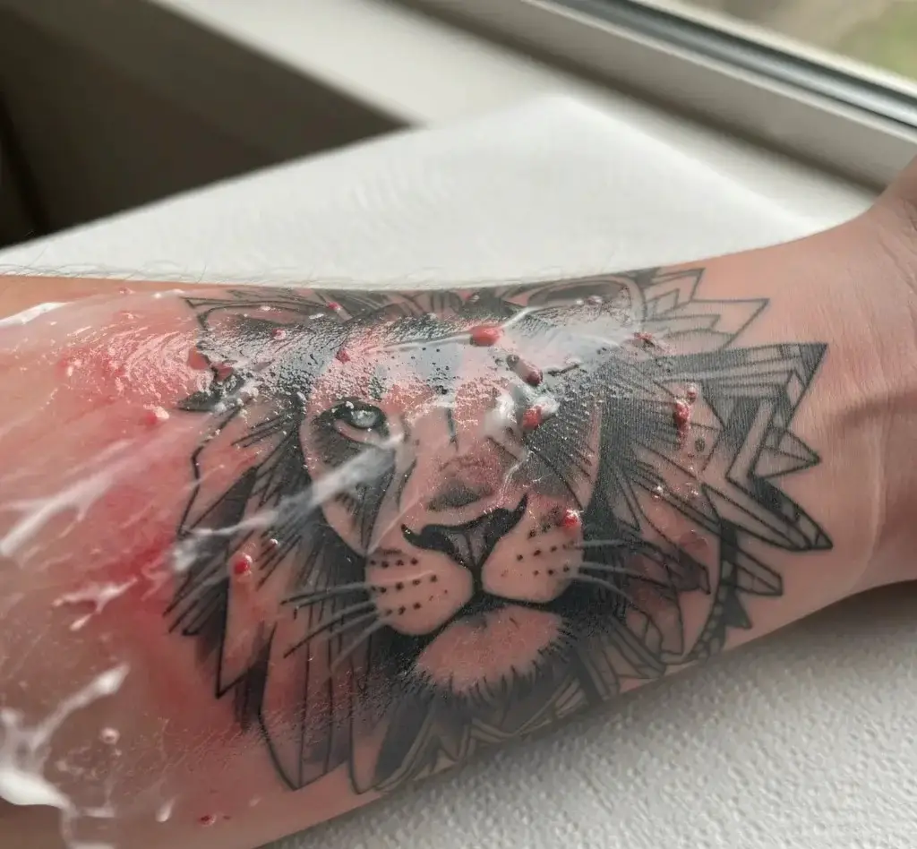 Tattoo Burns After Lotion