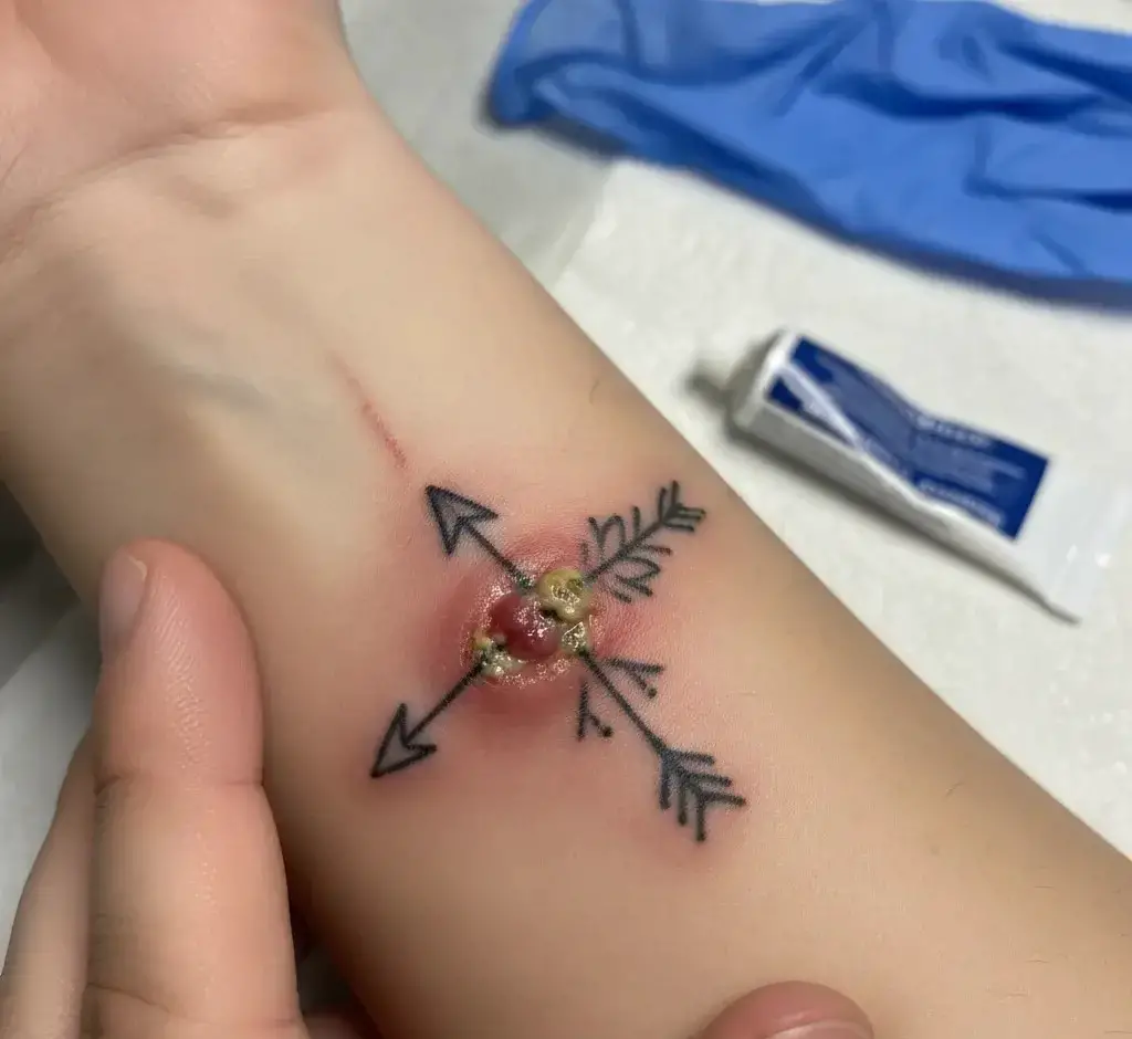 What Are the Signs of Infection After Tattooing Over a Bite?